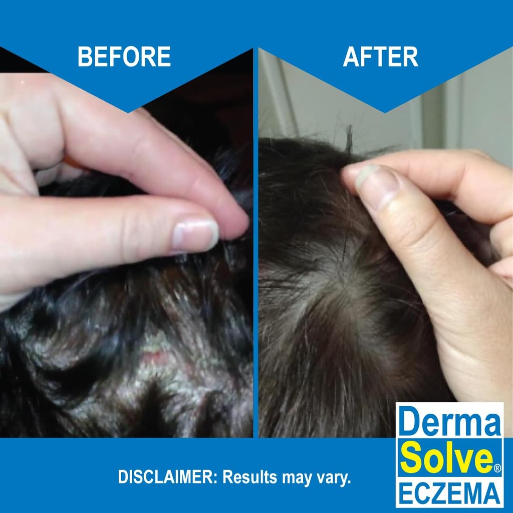eczema-shampoo-conditioner-combo-pack----3.jpg