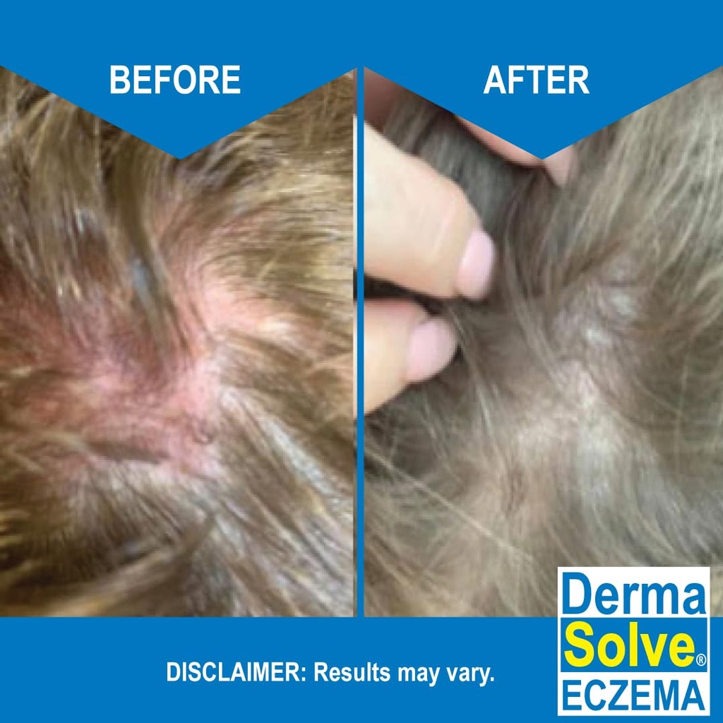 eczema-shampoo-conditioner-combo-pack----5.jpg
