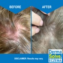 eczema-shampoo-conditioner-combo-pack----5.jpg