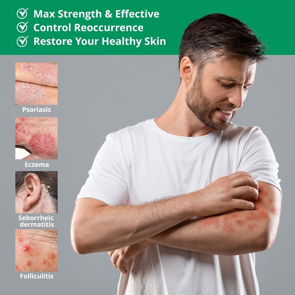 hermon-psoriasis-eczema-relief-cream-max-2.jpg