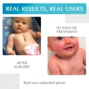 advanced-silicone-scar-treatment-sheets--3.jpg
