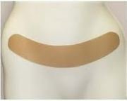 37CS C Section Scar Shape.