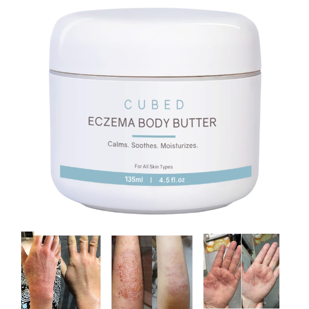 oz Eczema Cream for Adults, Eczema Relief, Eczema Treatment, Moisturize יבש Irridated Skin, Smart Lotion for Topical Steroid , Psoriasis & Rosacea, Eczema, Dermatitis